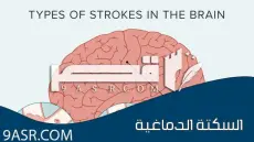 كيف تقي نفسك من السكتة الدماغية؟