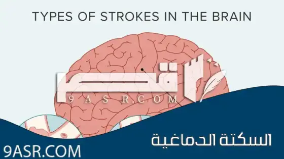 كيف تقي نفسك من السكتة الدماغية؟